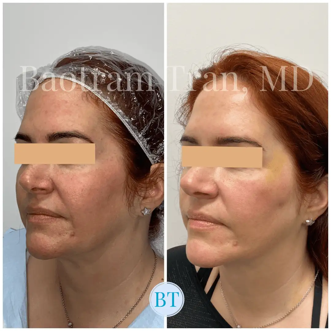 Before and After Image: Facial Thread Lift - left-front-oblique