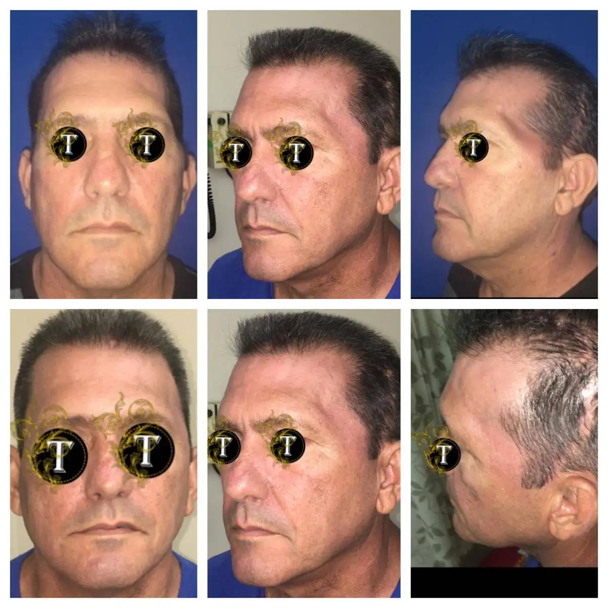 Before and After Image: Facial Reconstruction - front