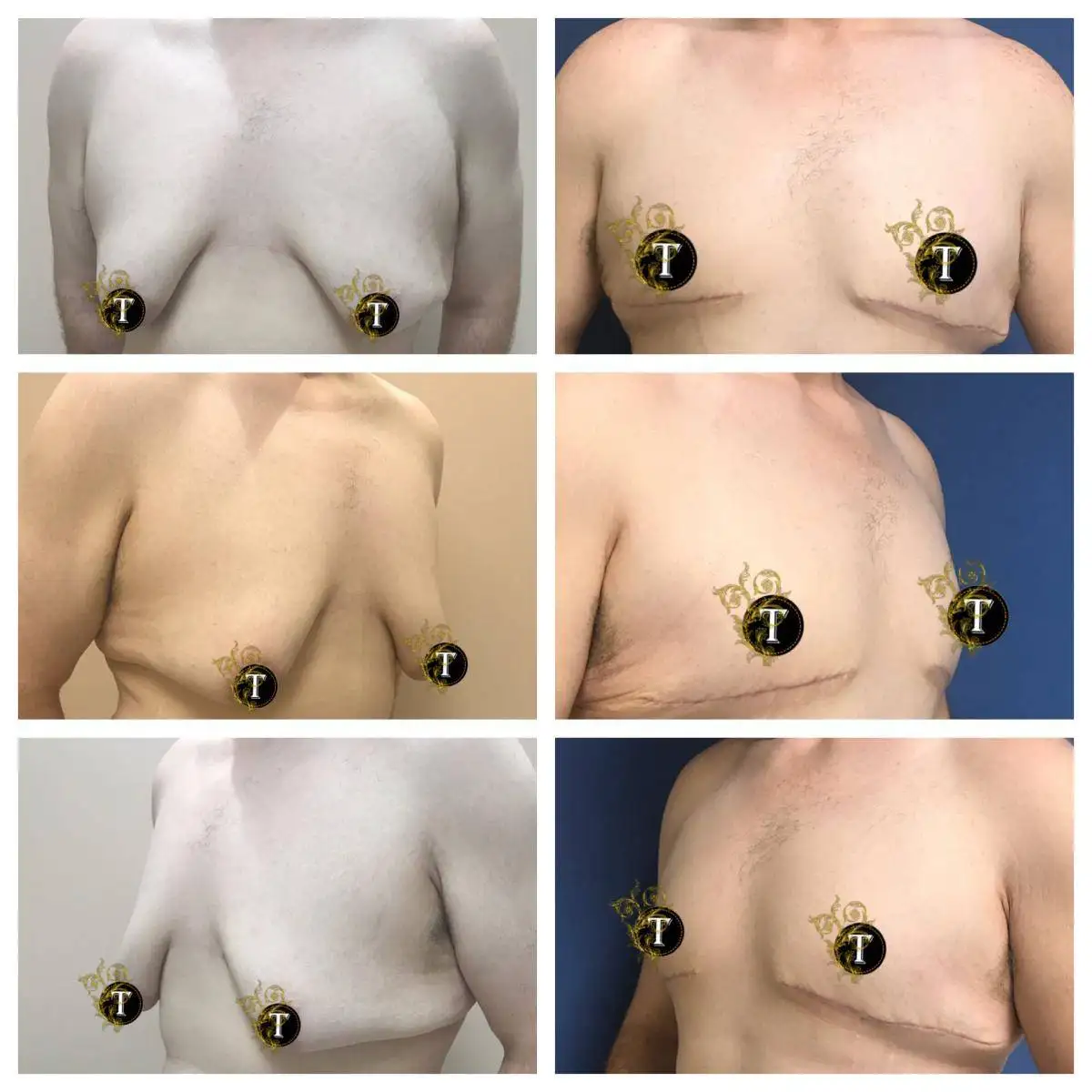 Before and After Image: Gynecomastia - front