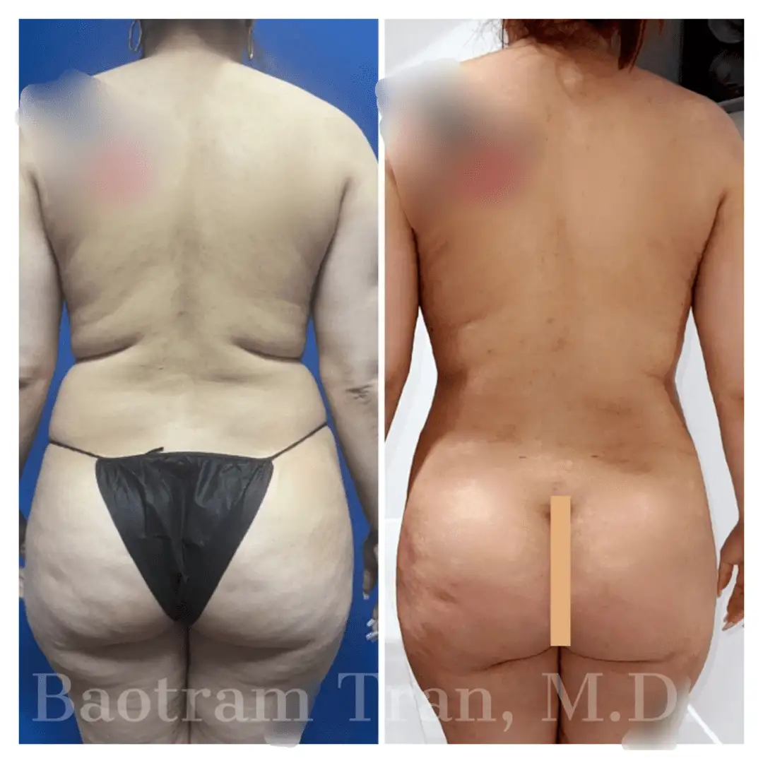Before and After Image: Liposuction - 
