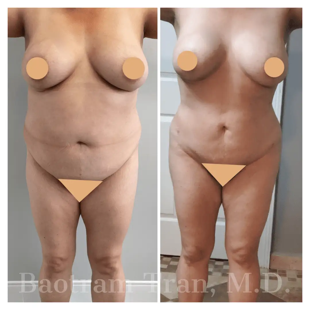 Before and After Image: Liposuction - front