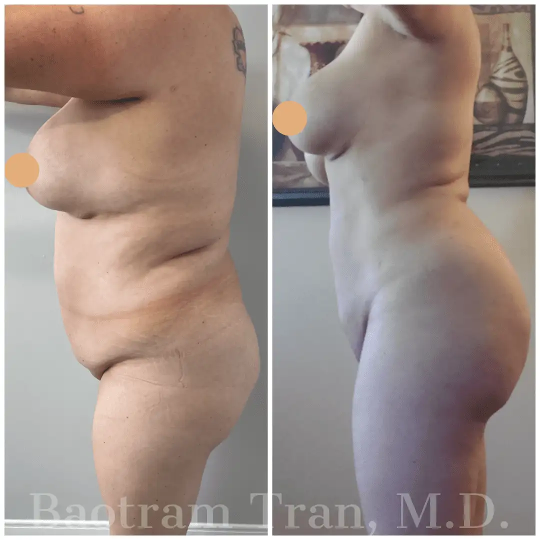 Before and After Image: Liposuction - 