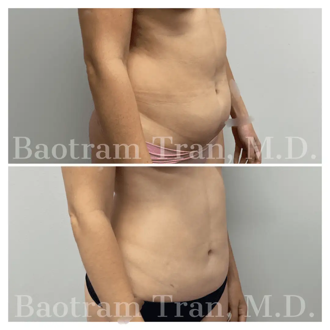 Before and After Image: Liposuction - right-front-oblique