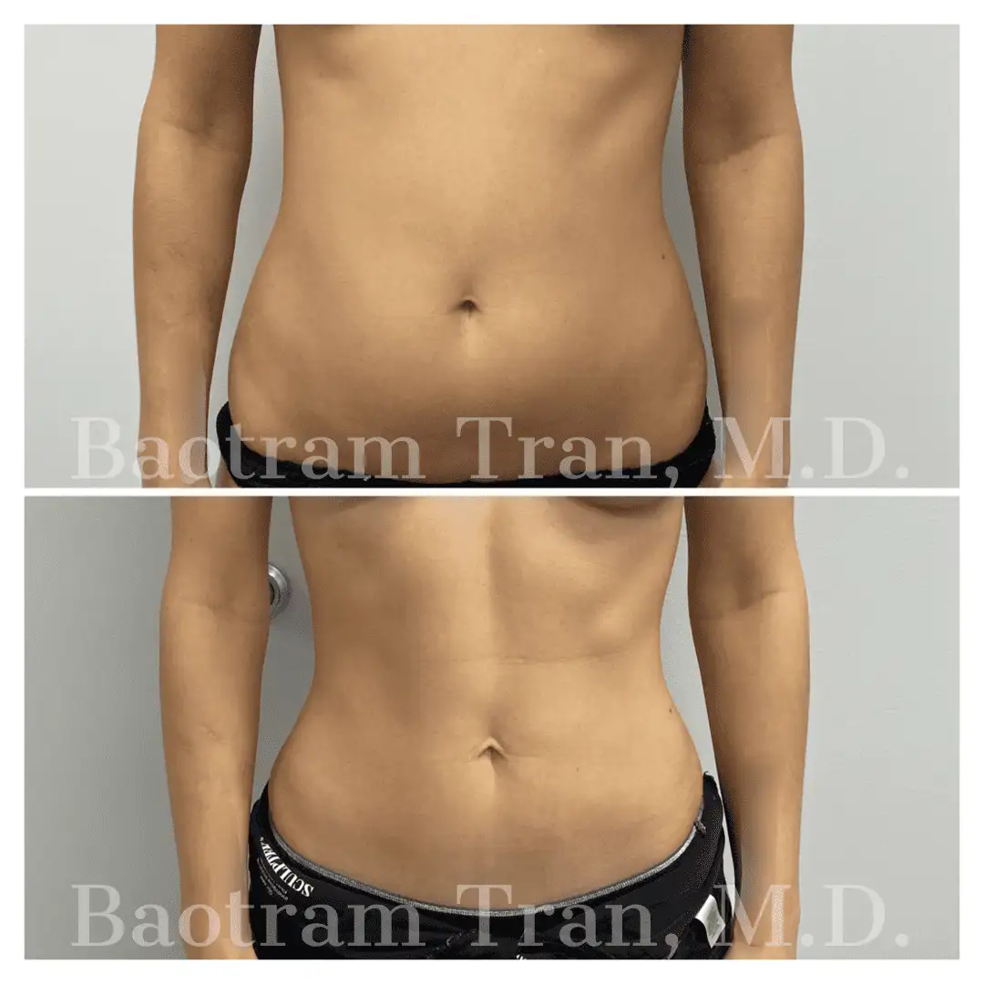 Before and After Image: Liposuction - front