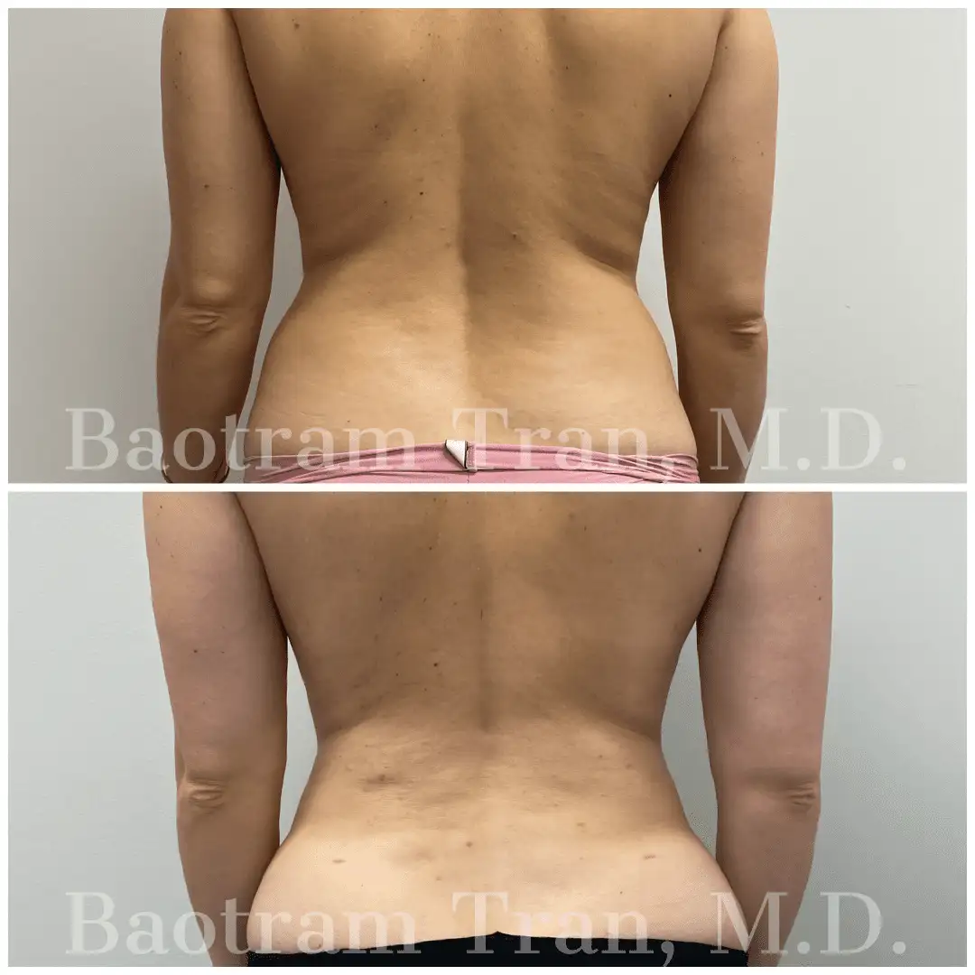 Before and After Image: Liposuction - back
