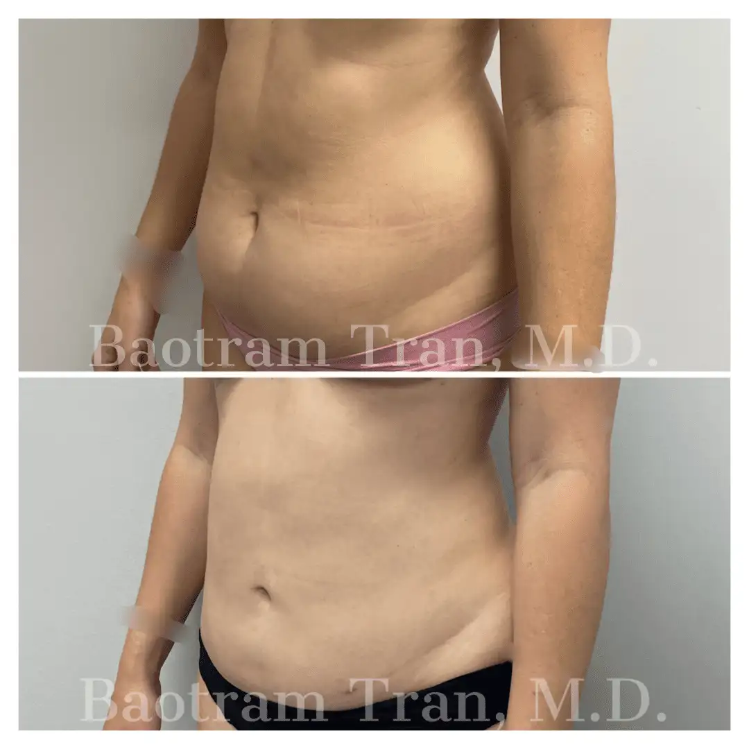 Before and After Image: Liposuction - left-front-oblique