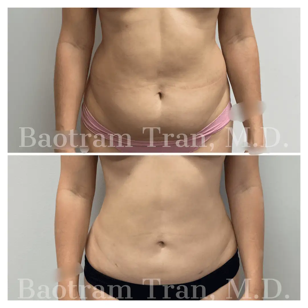 Before and After Image: Liposuction - front