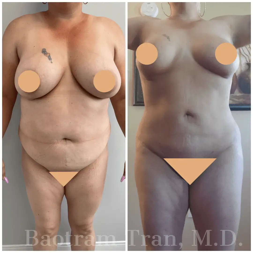 Before and After Image: Liposuction - front