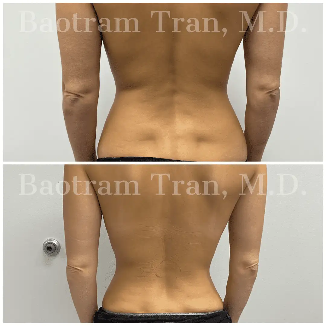 Before and After Image: Liposuction - front