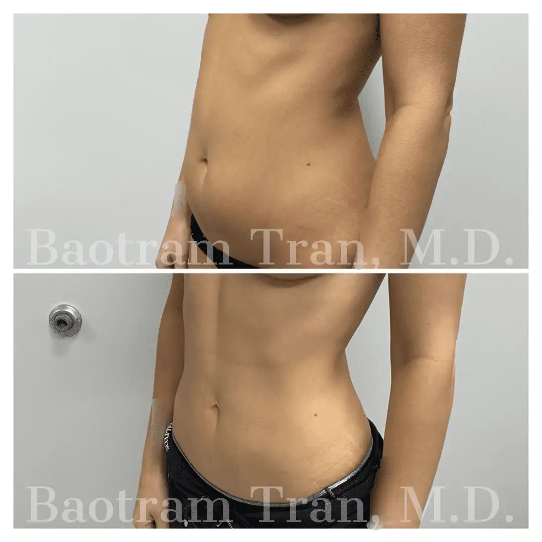 Before and After Image: Liposuction - left-front-oblique
