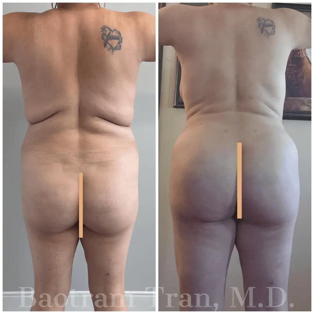Before and After Image: Liposuction - back