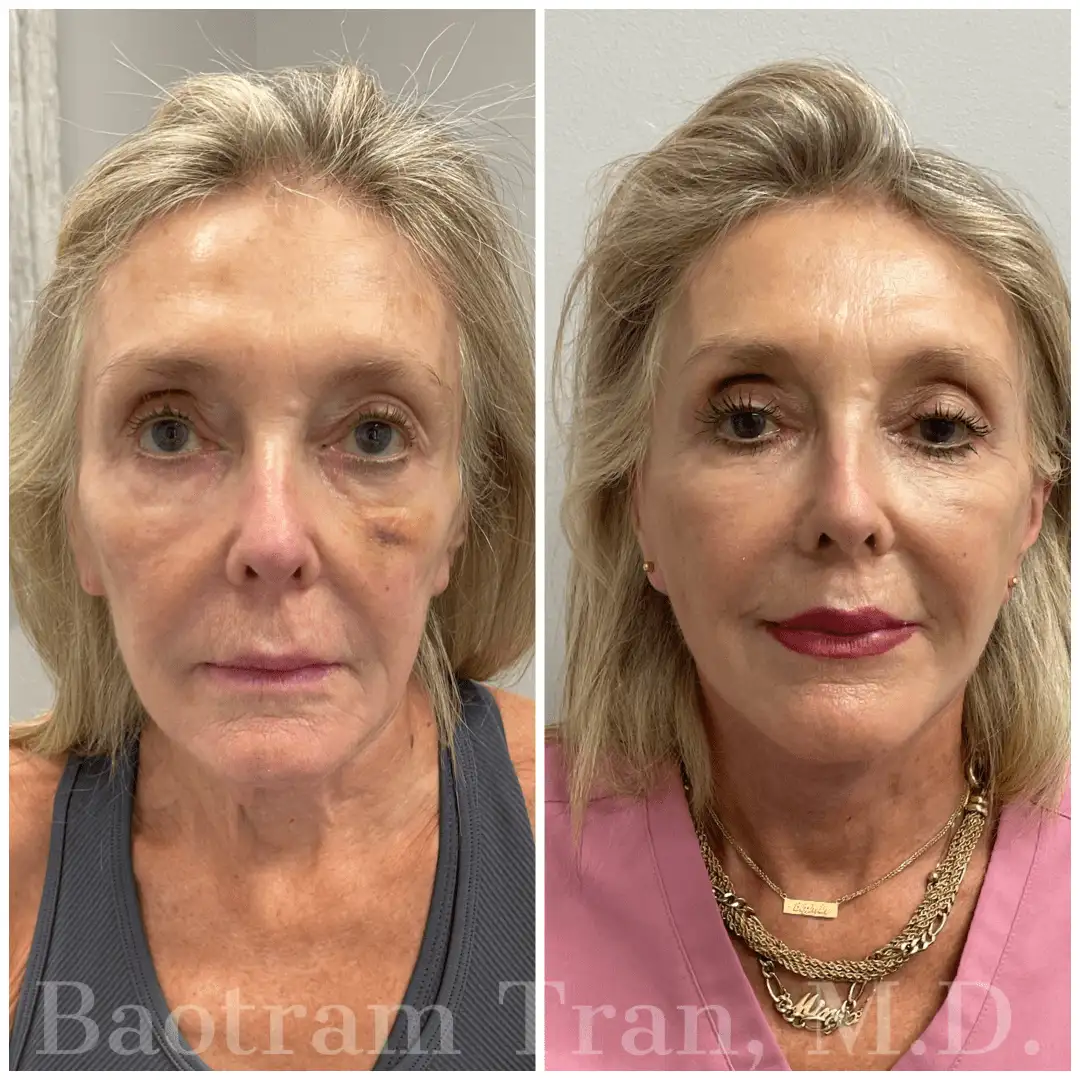 Before and After Image: Mini Facelift - front