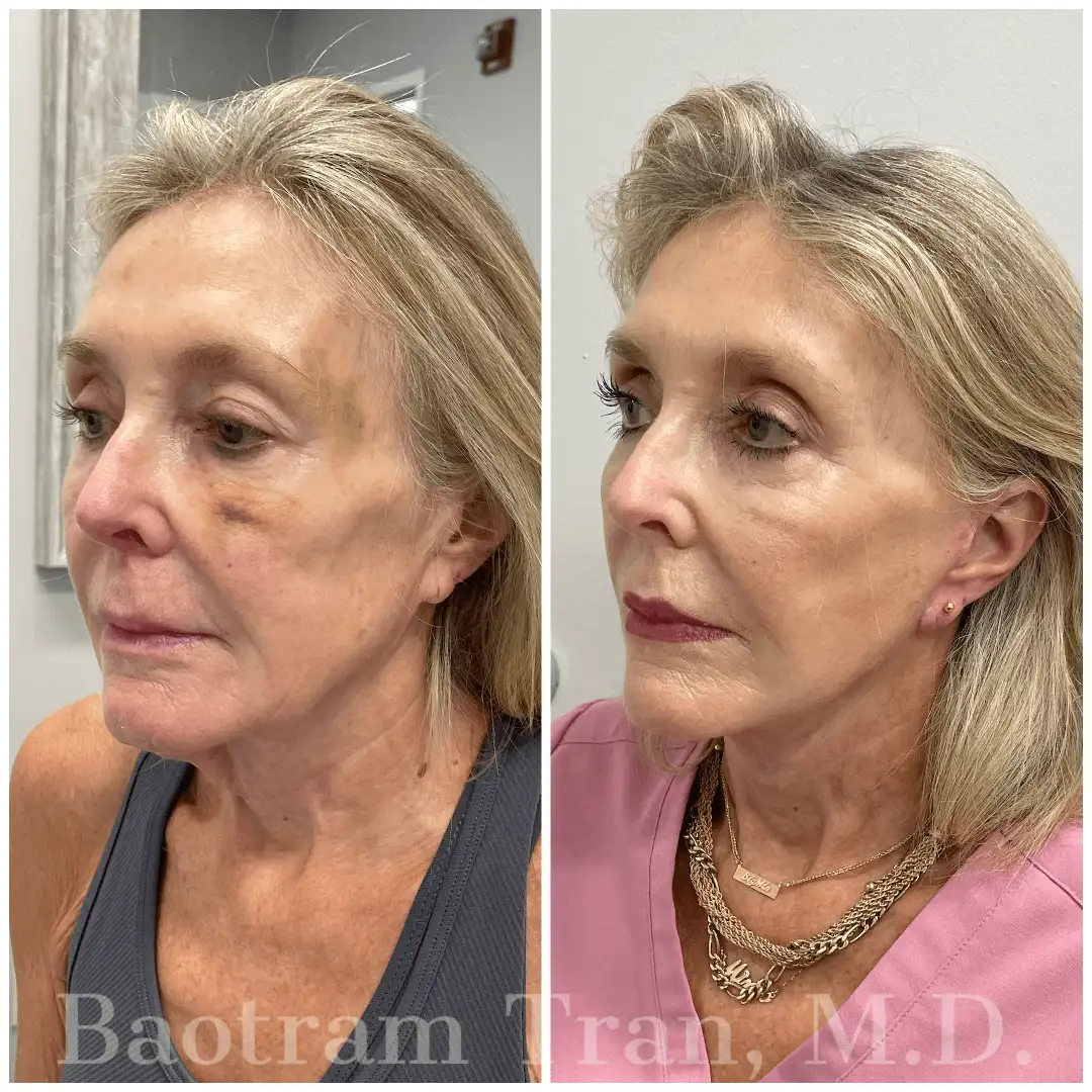 Before and After Image: Mini Facelift - left-front-oblique