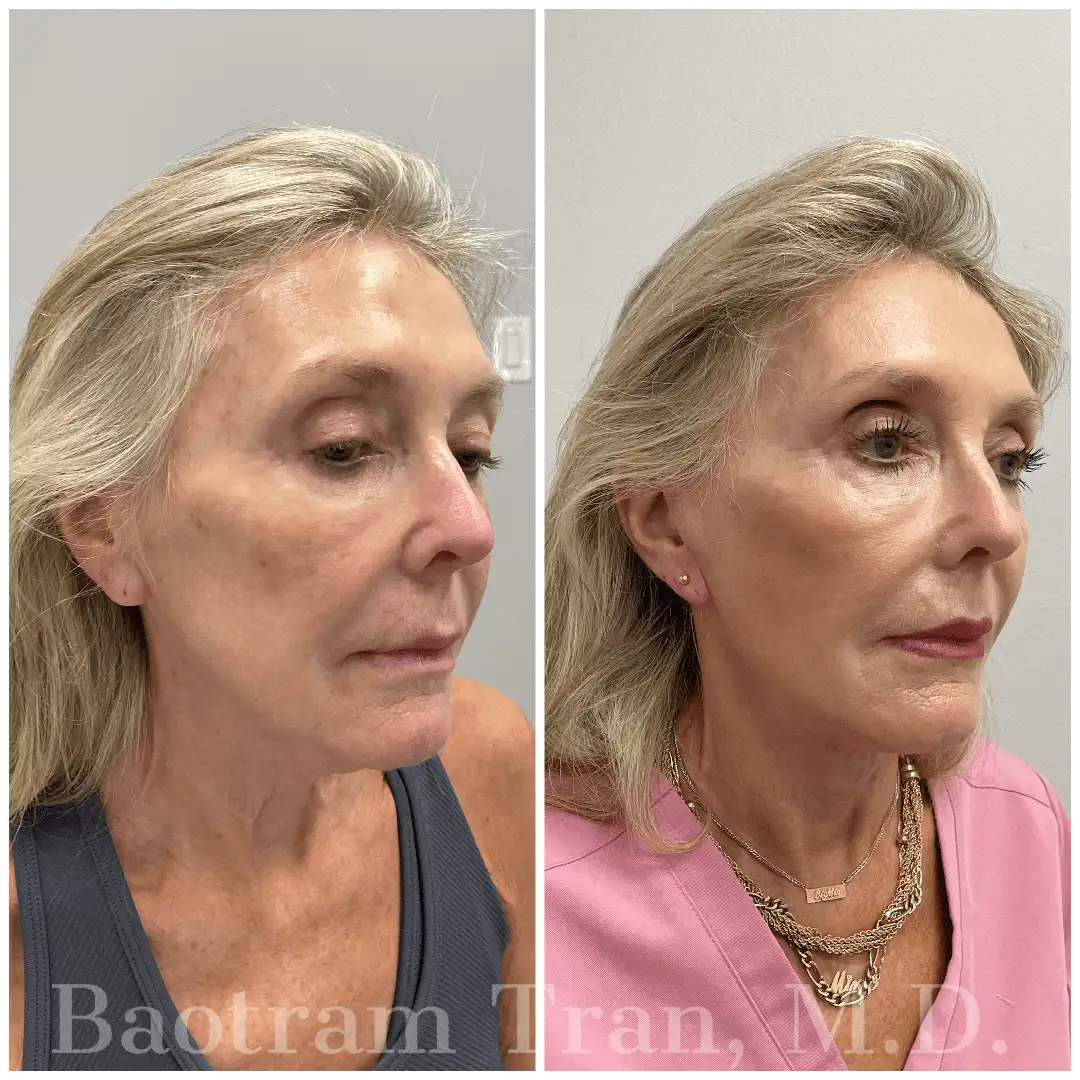 Before and After Image: Mini Facelift - right-front-oblique