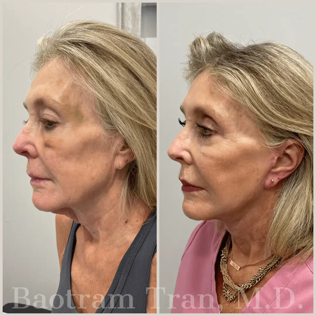 Before and After Image: Mini Facelift - left-side