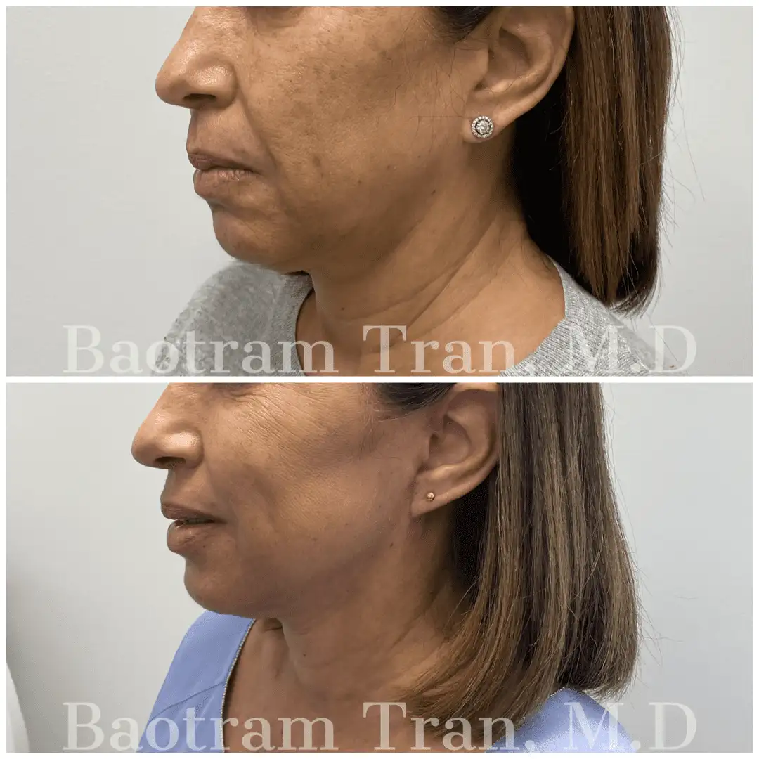 Before and After Image: Mini Facelift - left-side