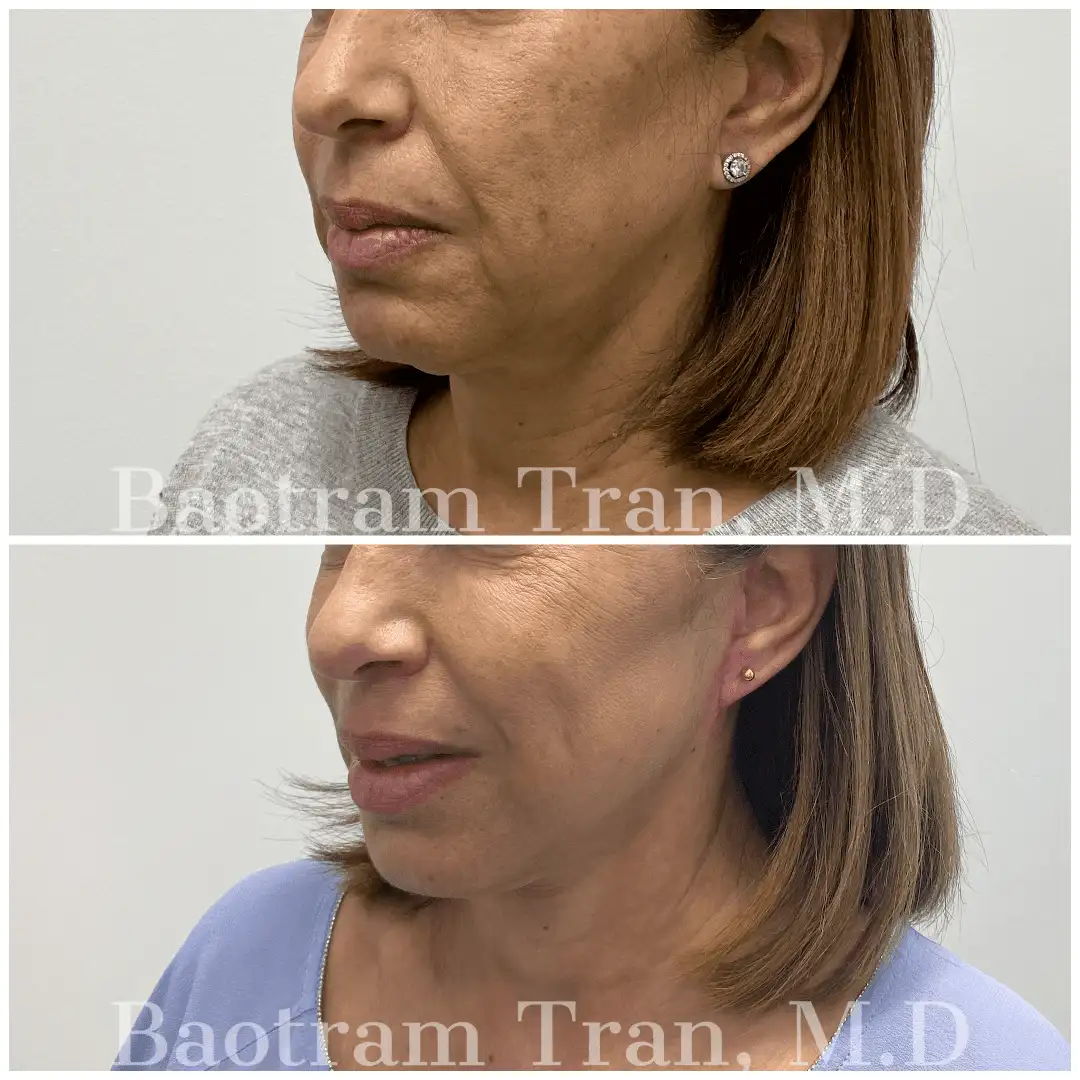 Before and After Image: Mini Facelift - left-front-oblique