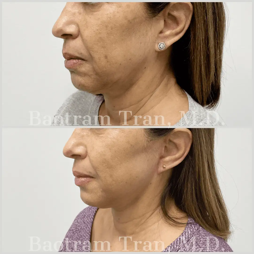 Before and After Image: Mini Facelift - left-front-oblique