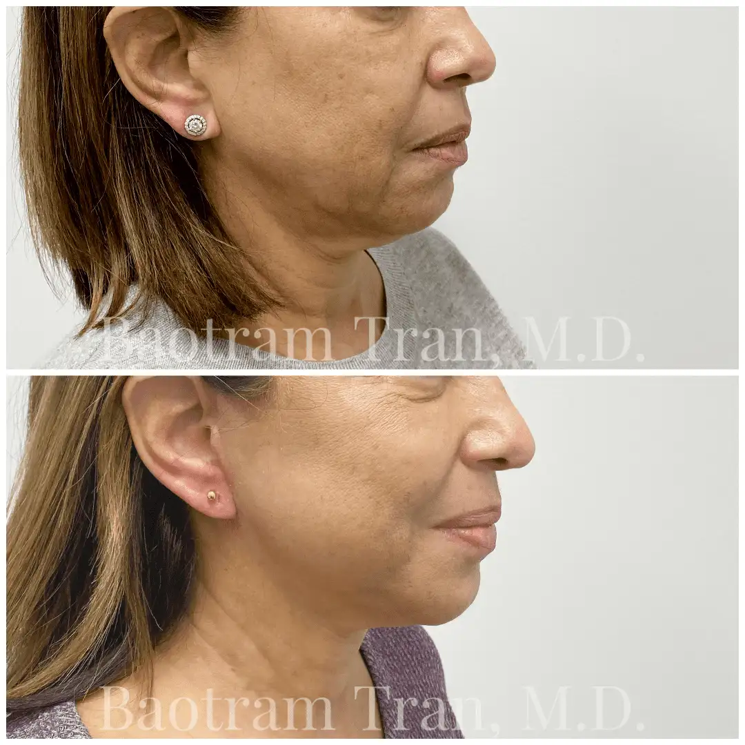 Before and After Image: Mini Facelift - right-front-oblique