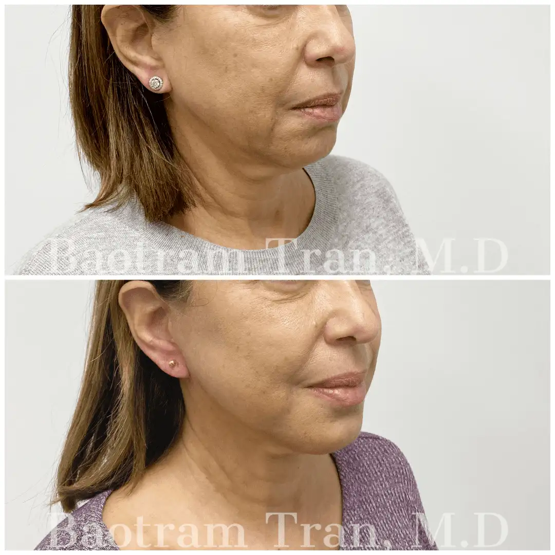 Before and After Image: Mini Facelift - right-front-oblique