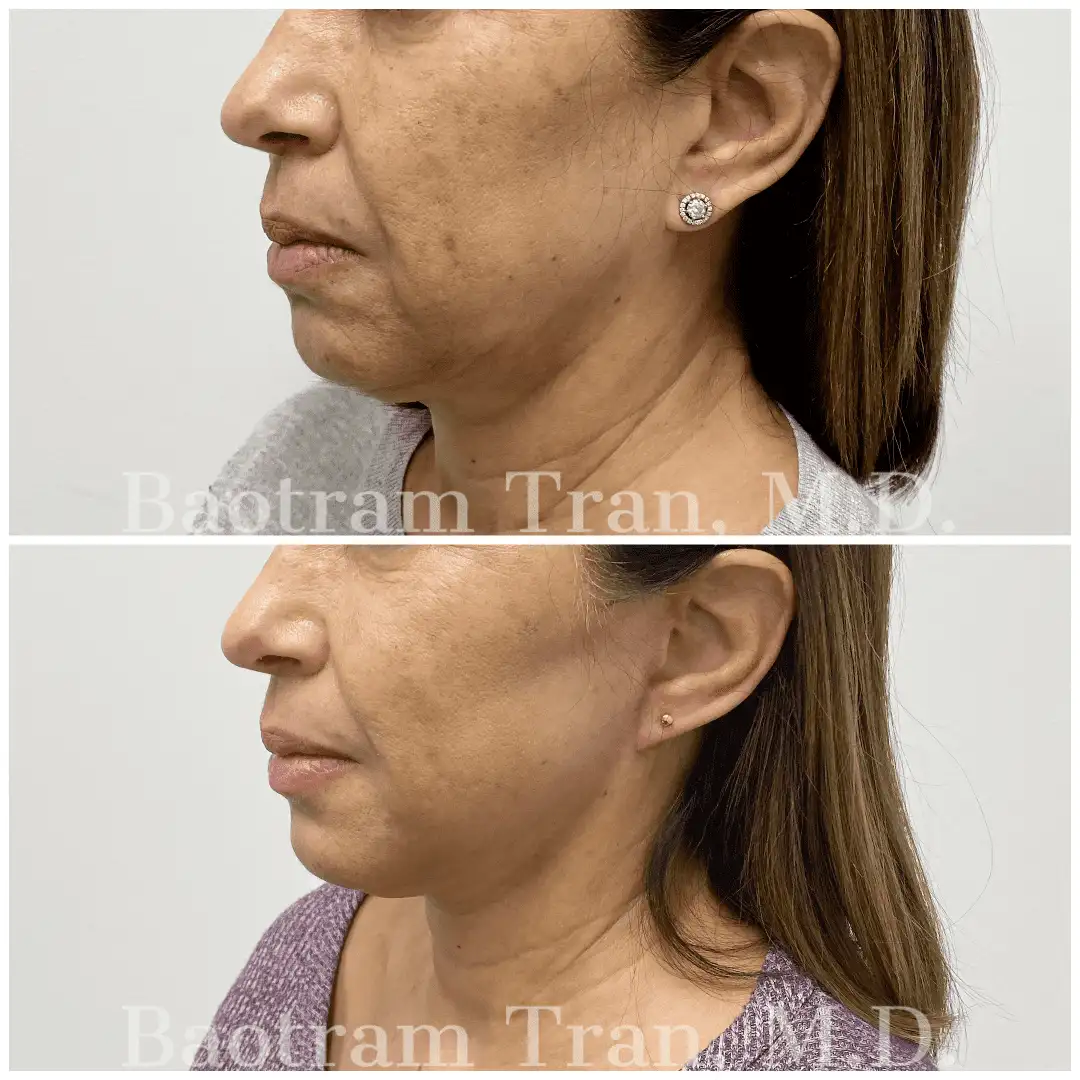 Before and After Image: Mini Facelift - left-front-oblique