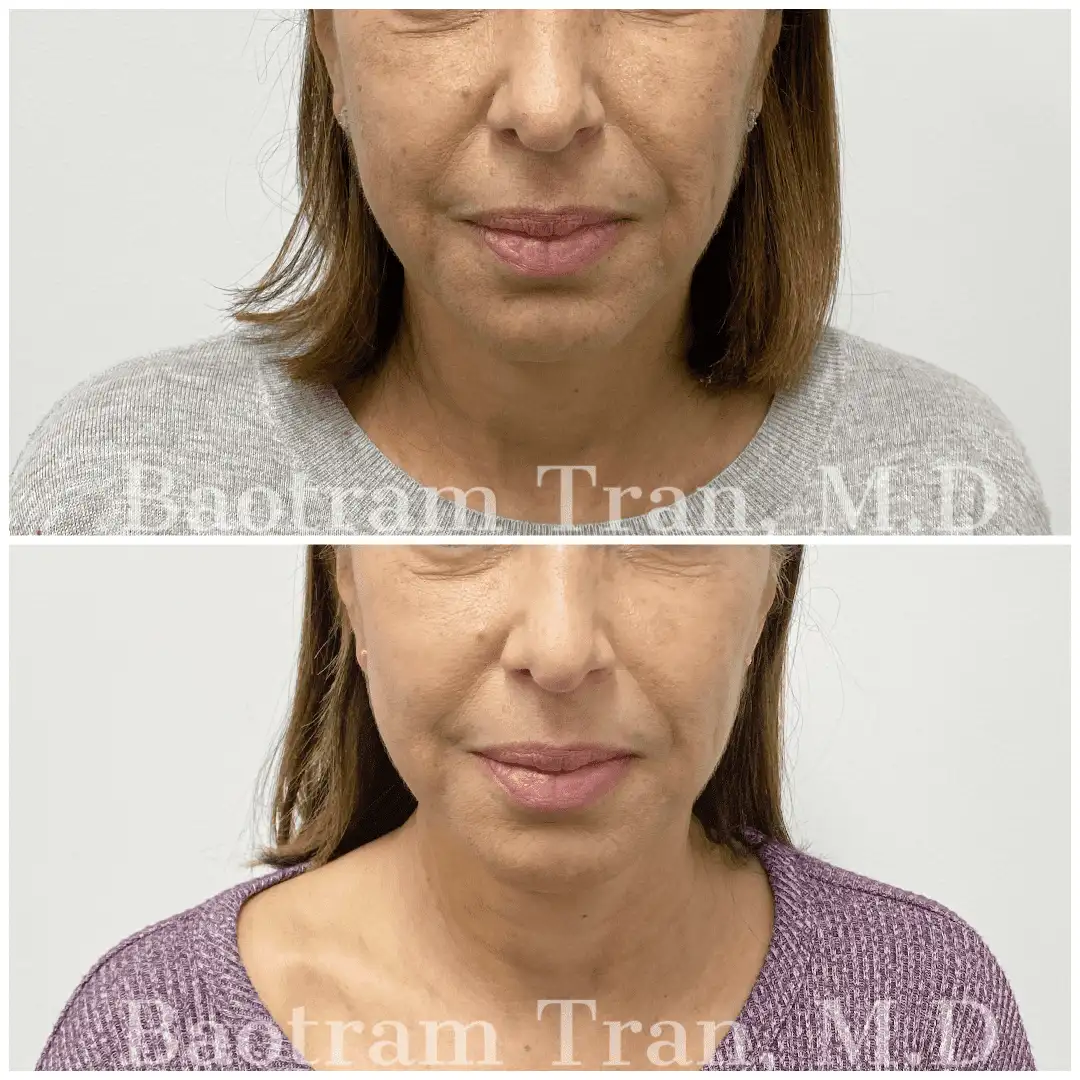 Before and After Image: Mini Facelift - front