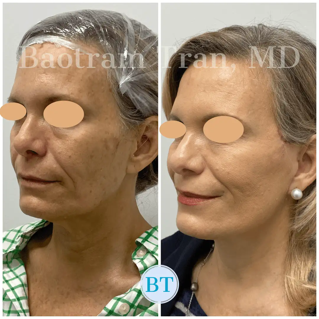 Before and After Image: Mini Facelift - left-front-oblique