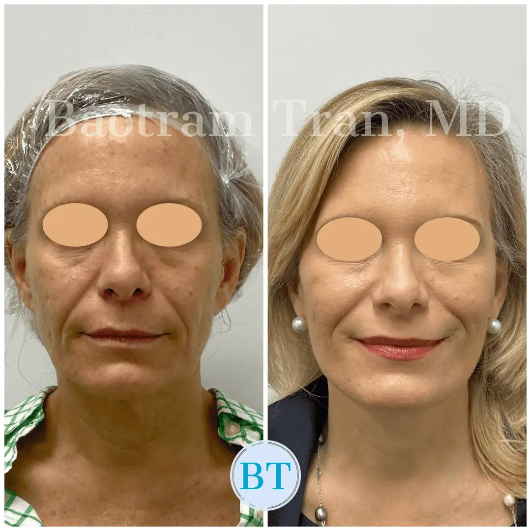 Before and After Image: Mini Facelift - front