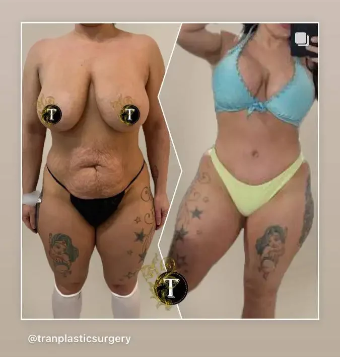 Before and After Image: Mommy Makeover - front