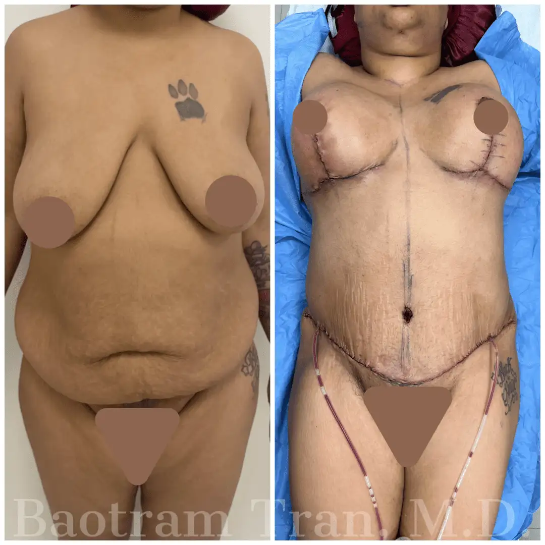 Before and After Image: Mommy Makeover - front