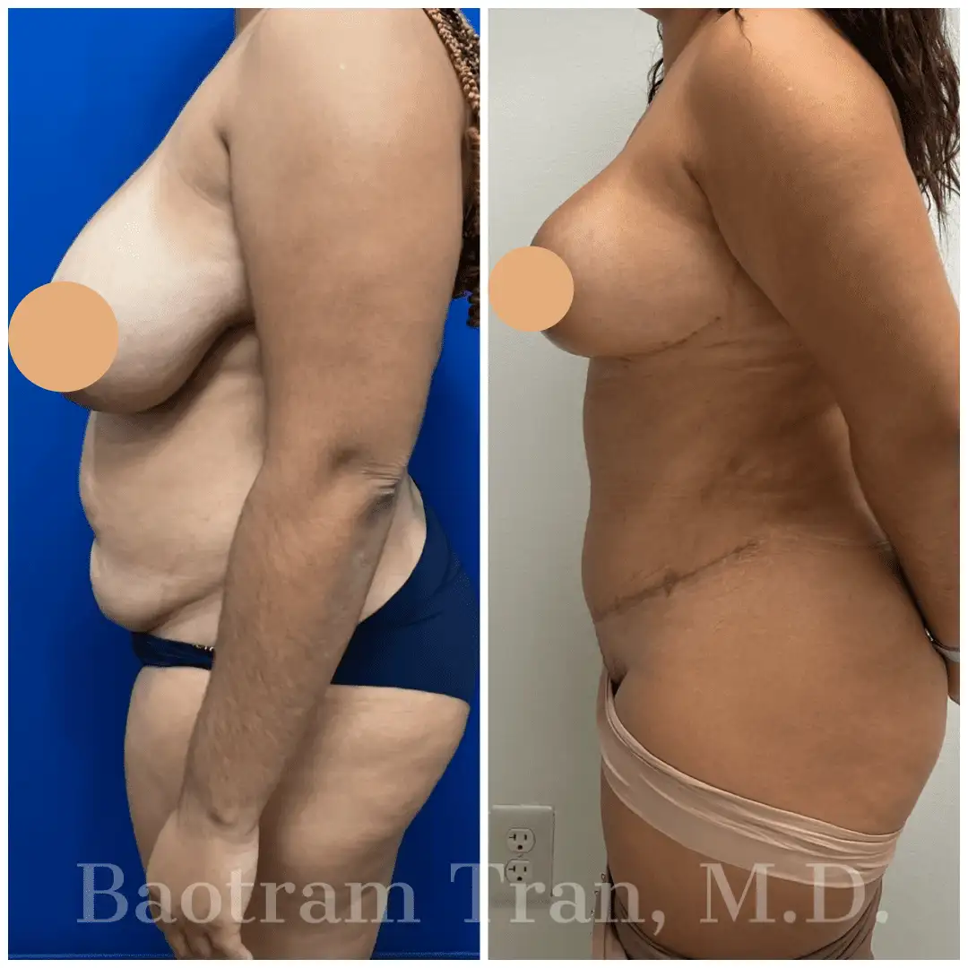 Before and After Image: Mommy Makeover - left-side