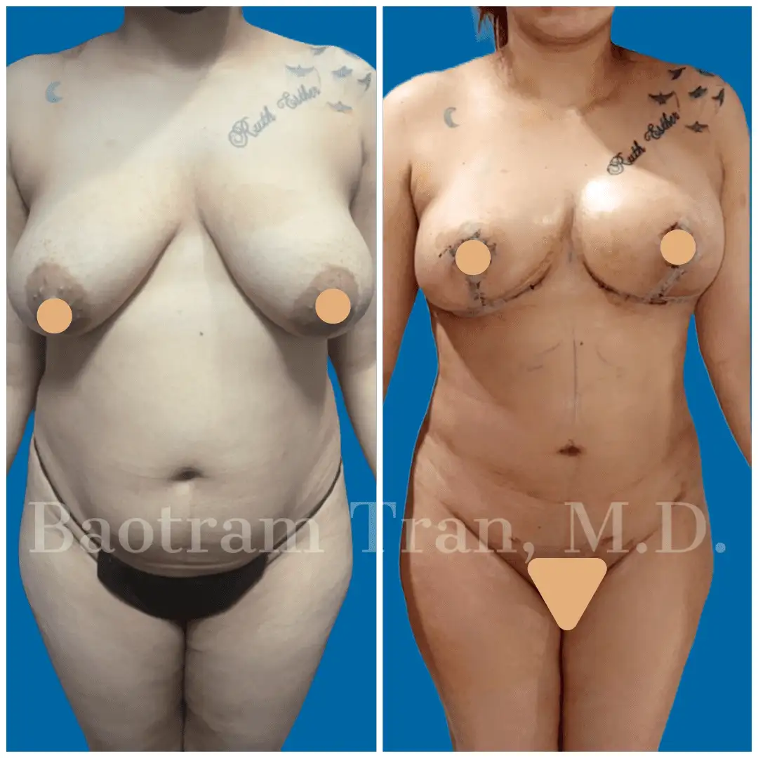 Before and After Image: Mommy Makeover - front