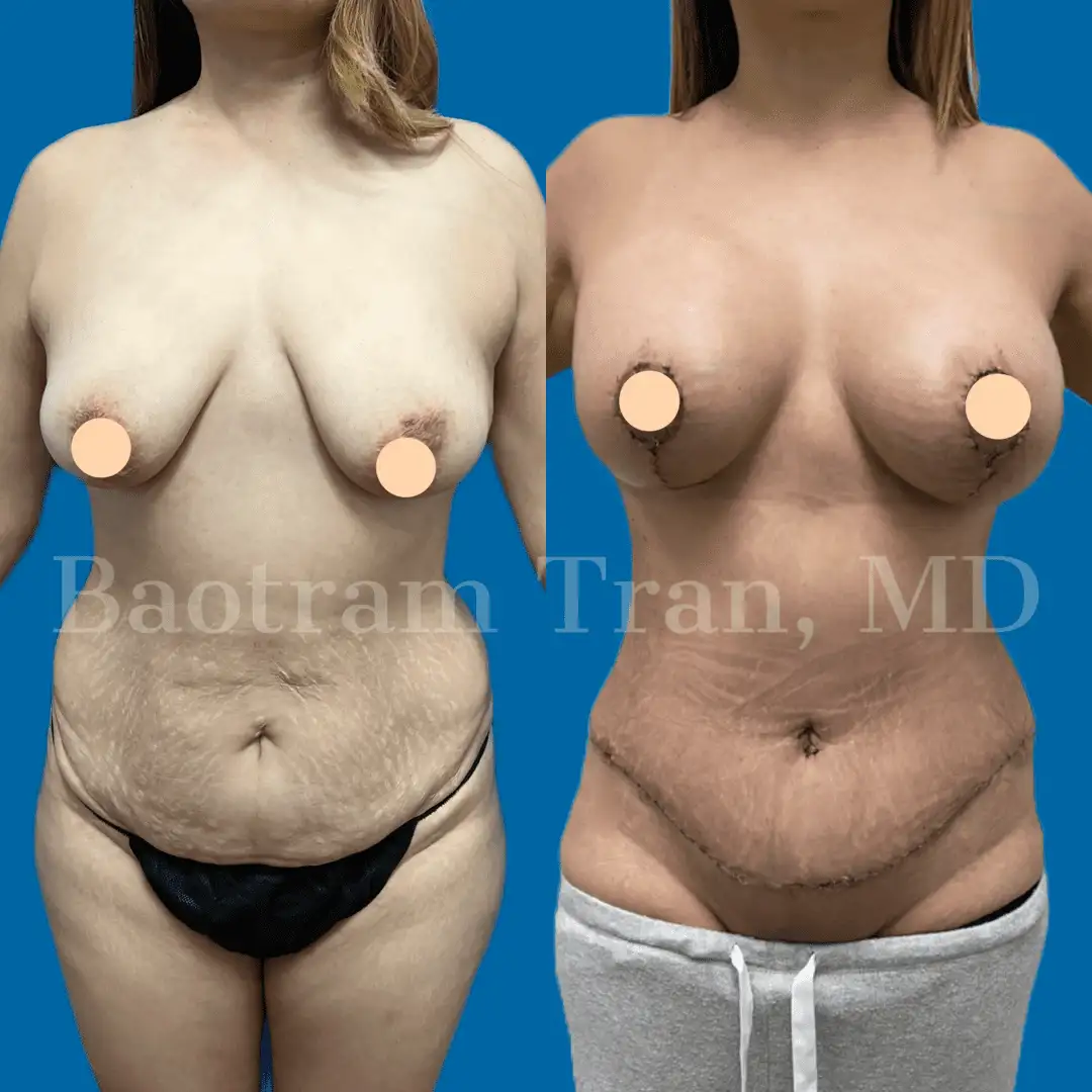 Before and After Image: Mommy Makeover - front