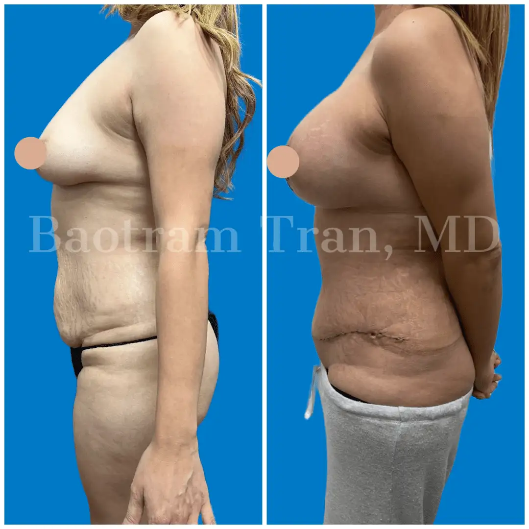 Before and After Image: Mommy Makeover - left-side