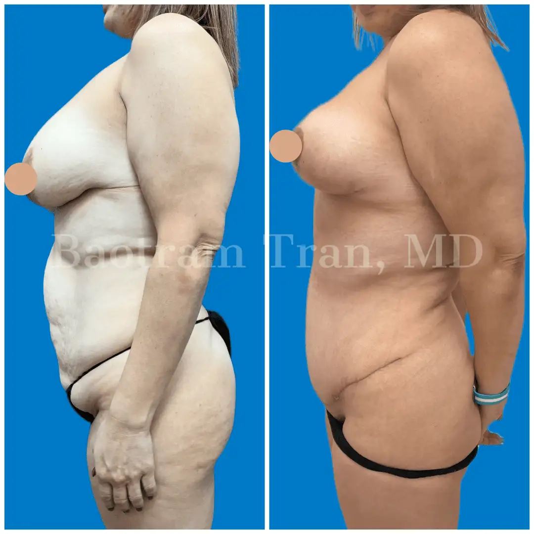 Before and After Image: Mommy Makeover - left-side