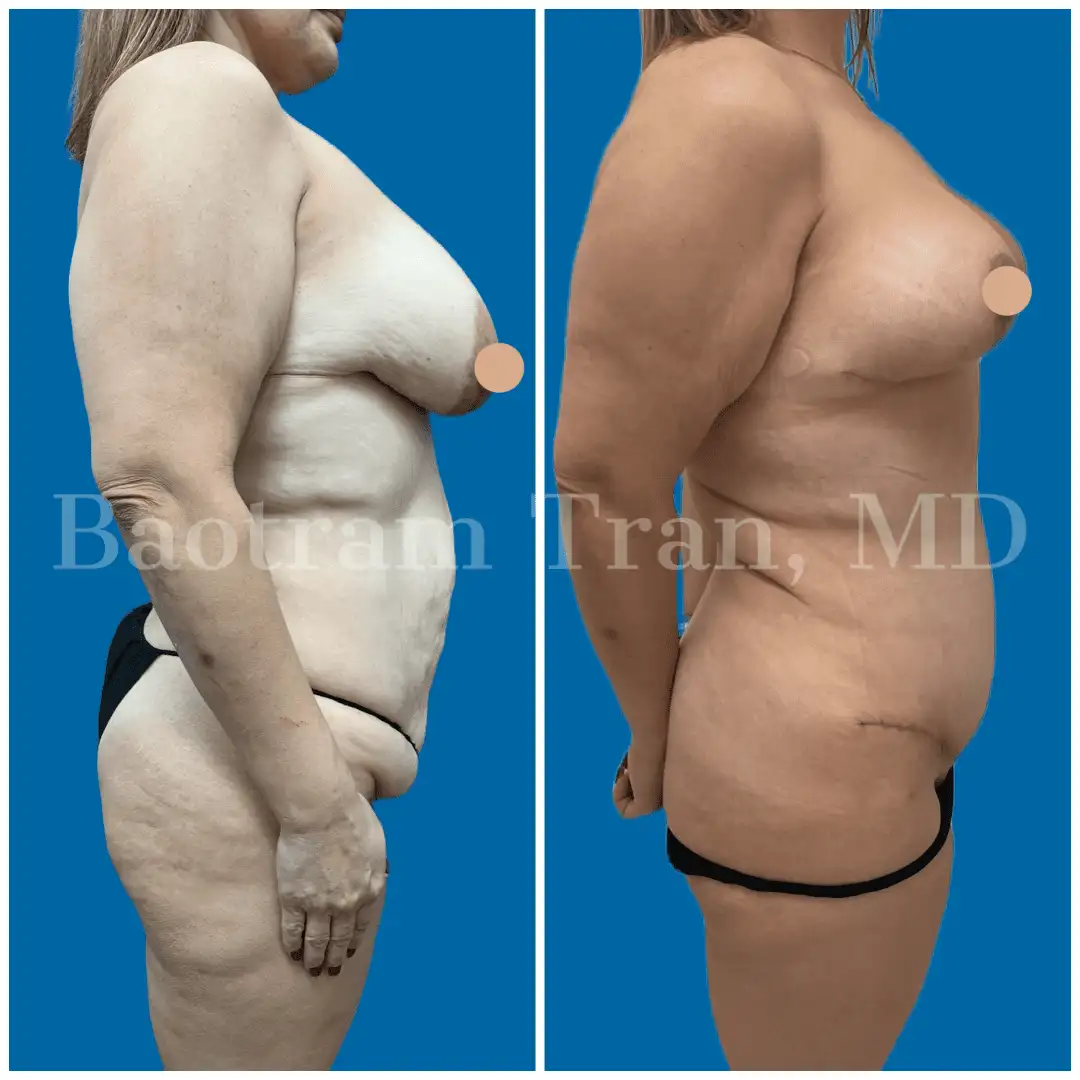 Before and After Image: Mommy Makeover - right-side