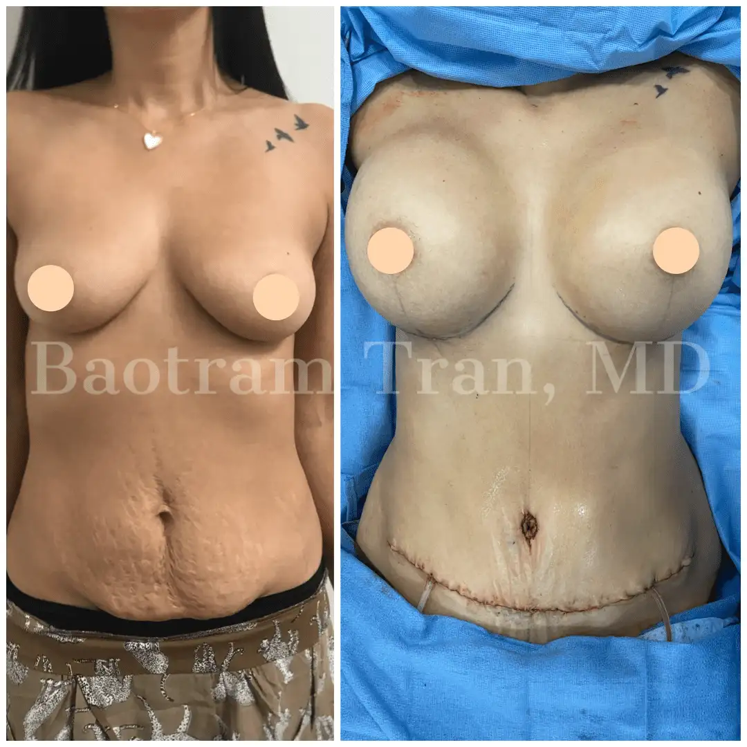 Before and After Image: Mommy Makeover - front