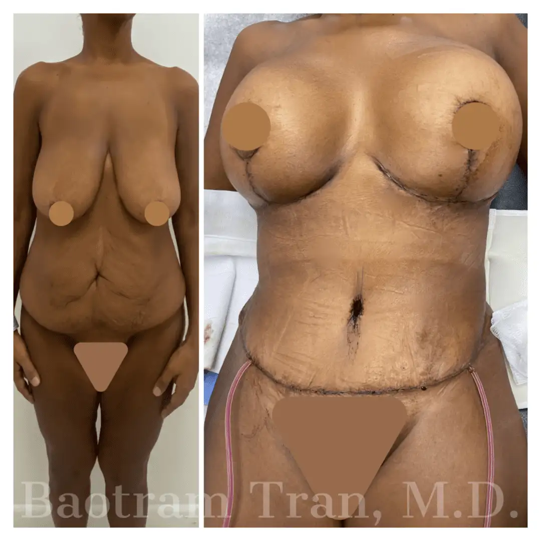 Before and After Image: Mommy Makeover - front