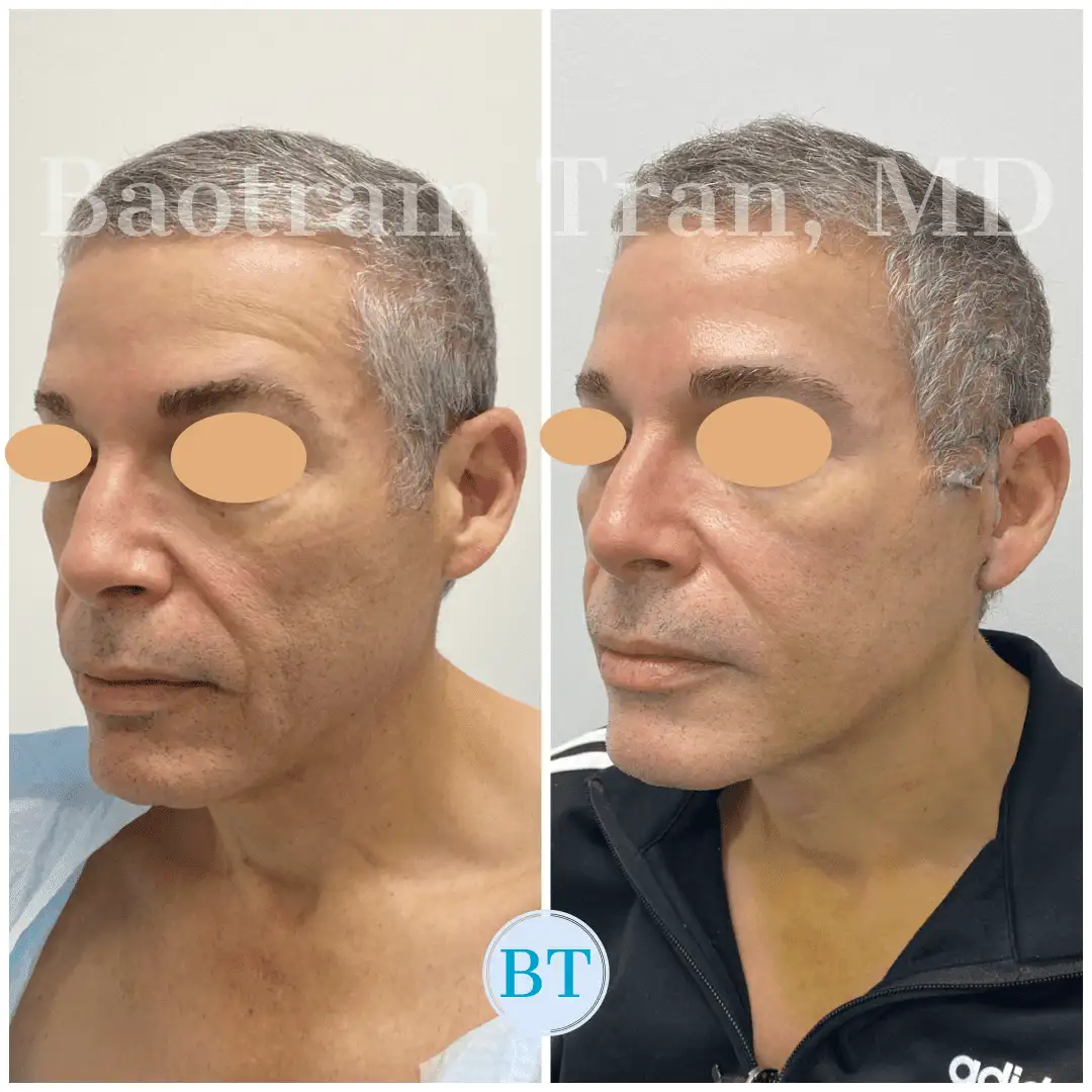 Before and After Image: Mini Facelift - left-front-oblique
