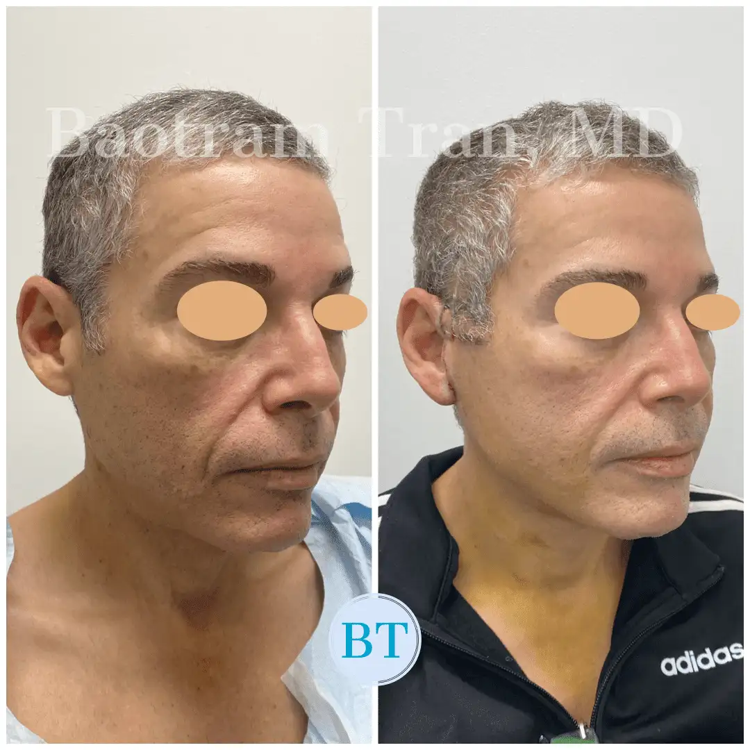 Before and After Image: Mini Facelift - right-front-oblique
