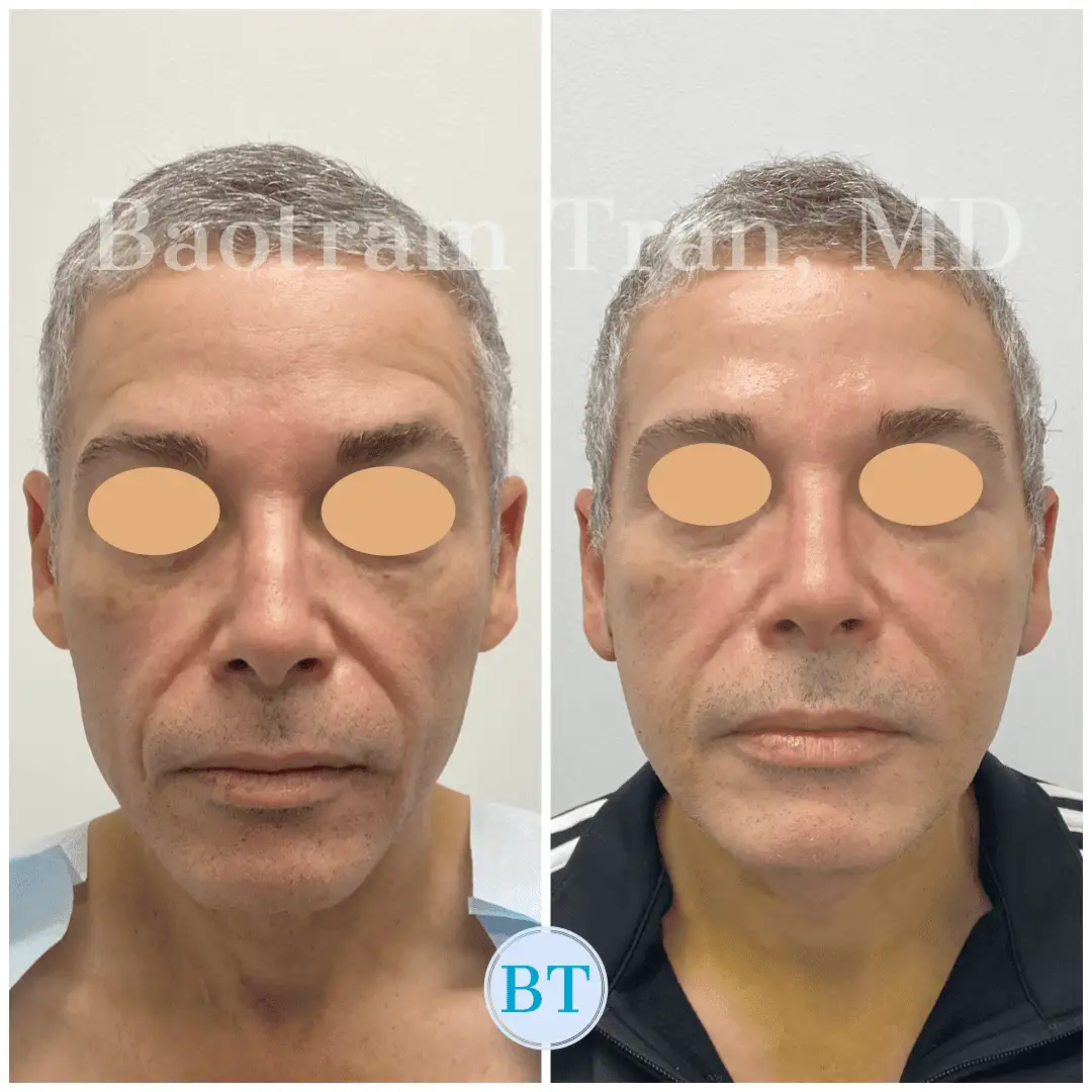 Before and After Image: Mini Facelift - front