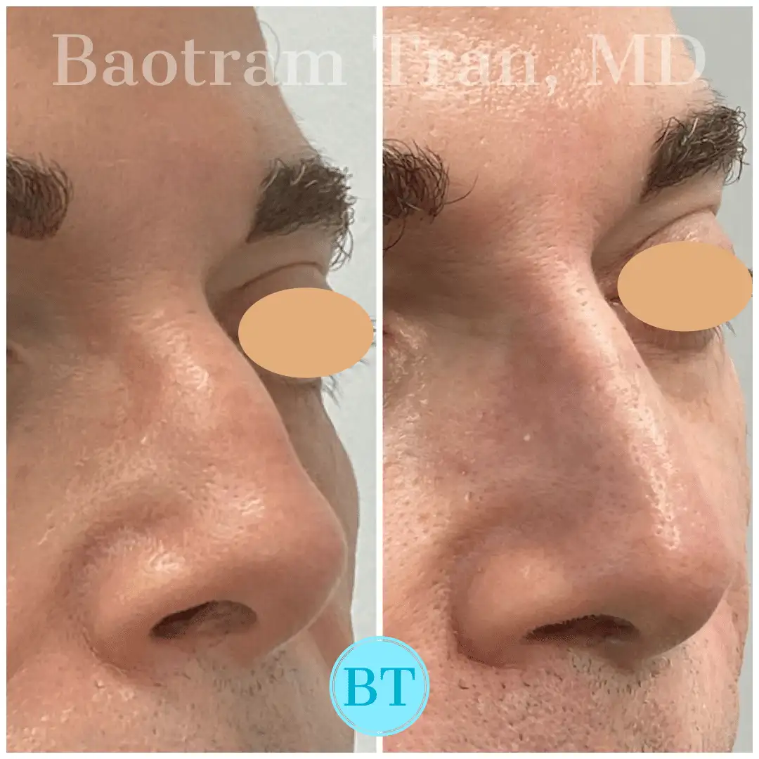 Before and After Image: Non-Surgical Procedure - right-front-oblique
