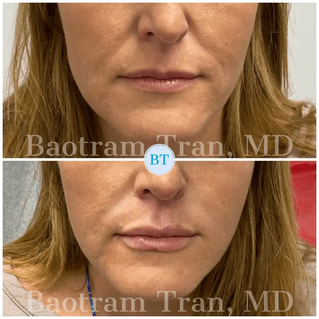 Before and After Image: Non-Surgical Procedure - front