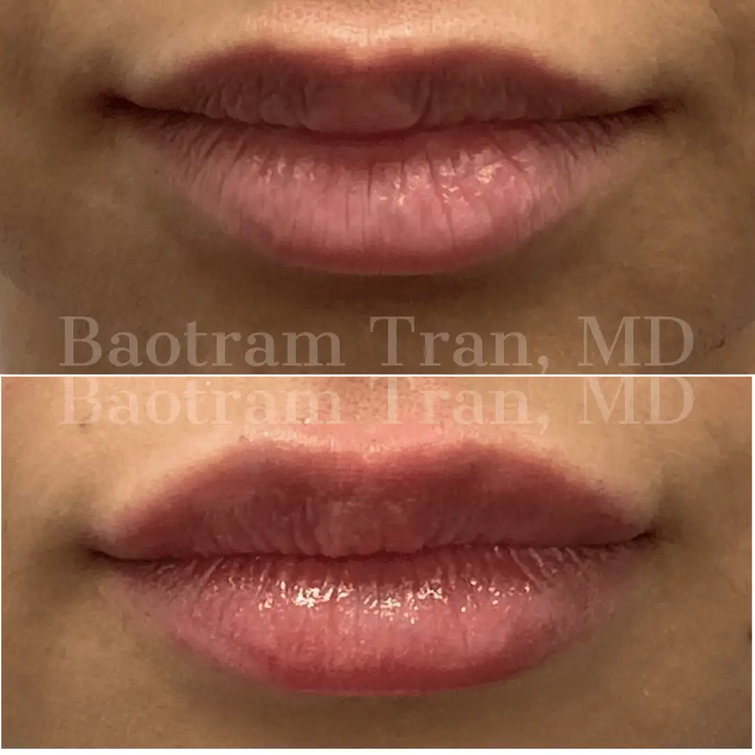 Before and After Image: Non-Surgical Procedure - front