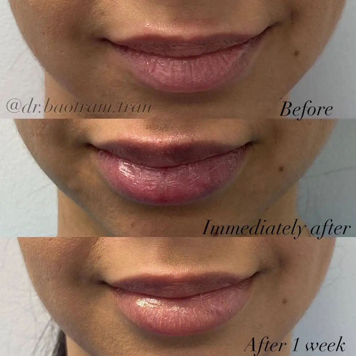 Before and After Image: Non-Surgical Procedure - front