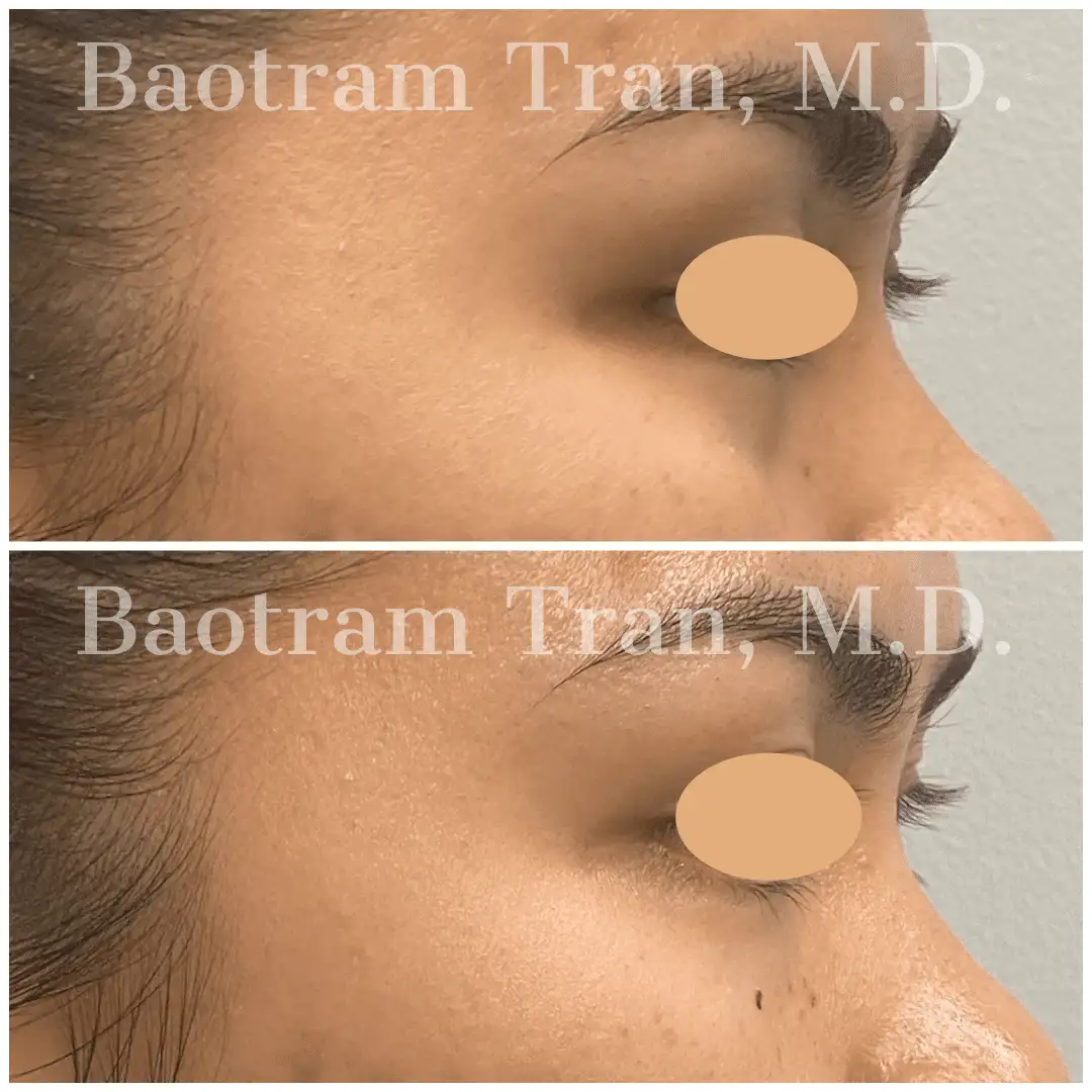 Before and After Image: Non-Surgical Procedure - right-side