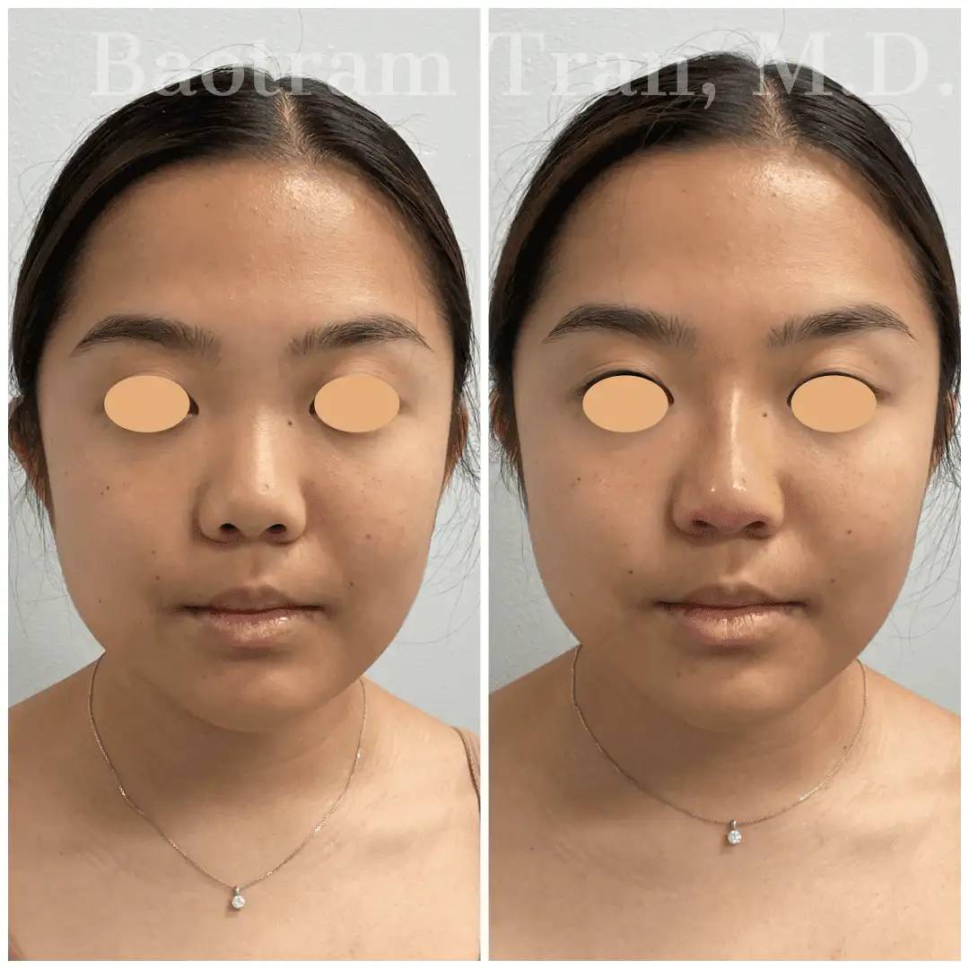 Before and After Image: Non-Surgical Procedure - front