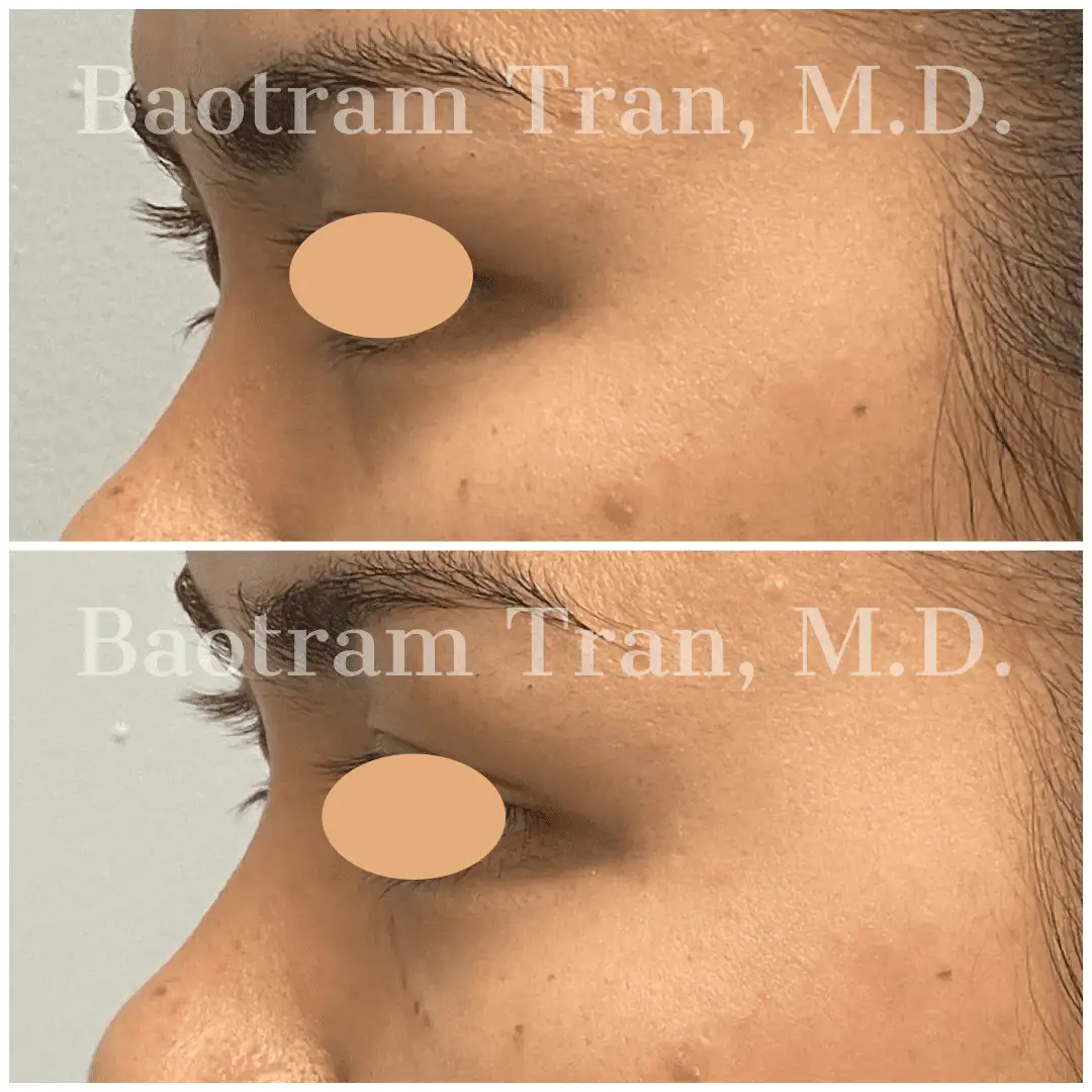 Before and After Image: Non-Surgical Procedure - left-side