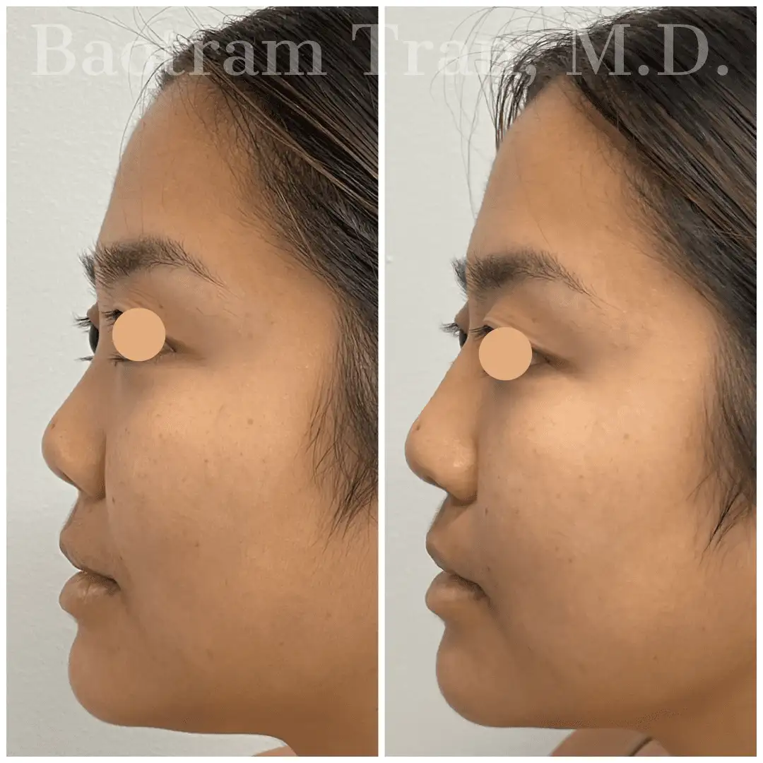 Before and After Image: Non-Surgical Procedure - left-side