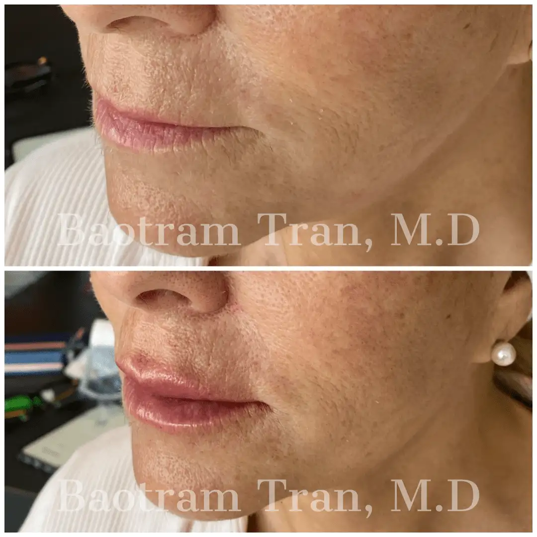 Before and After Image: Non-Surgical Procedure - 